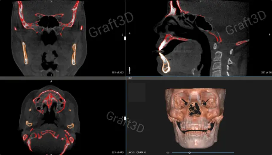 Customized implants and anatomical model designed in Oqton’s Geomagic Freeform