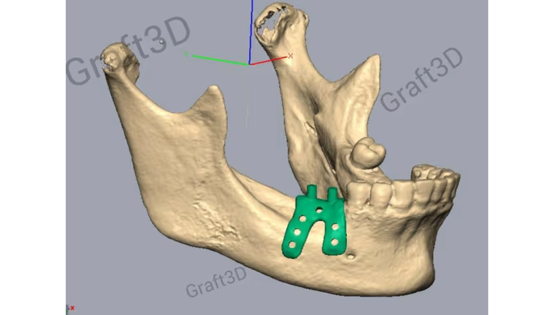 Modified ginwala incision and elevated buccal flap