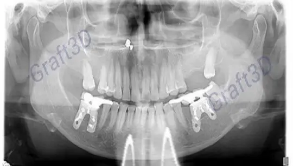 Post-operative orthopantomogram